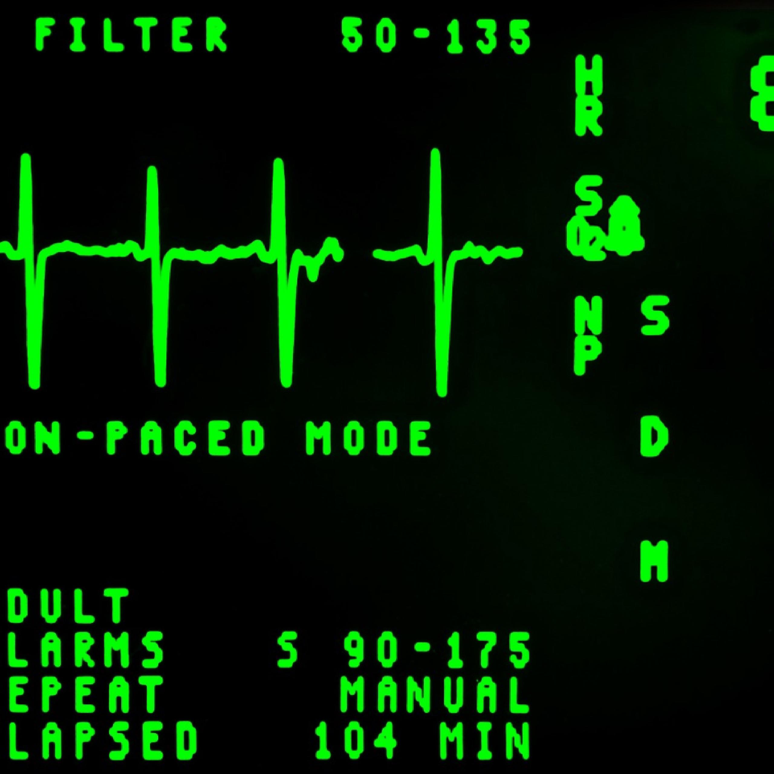 close up of EKG screen