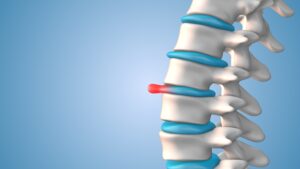 What Is the Average Settlement for a Bulging Disc?